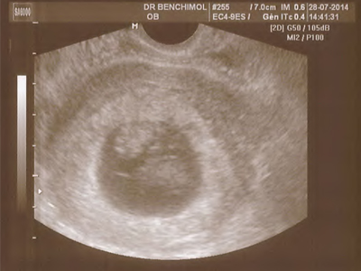 grossesse gemellaire monoamniotique 2
