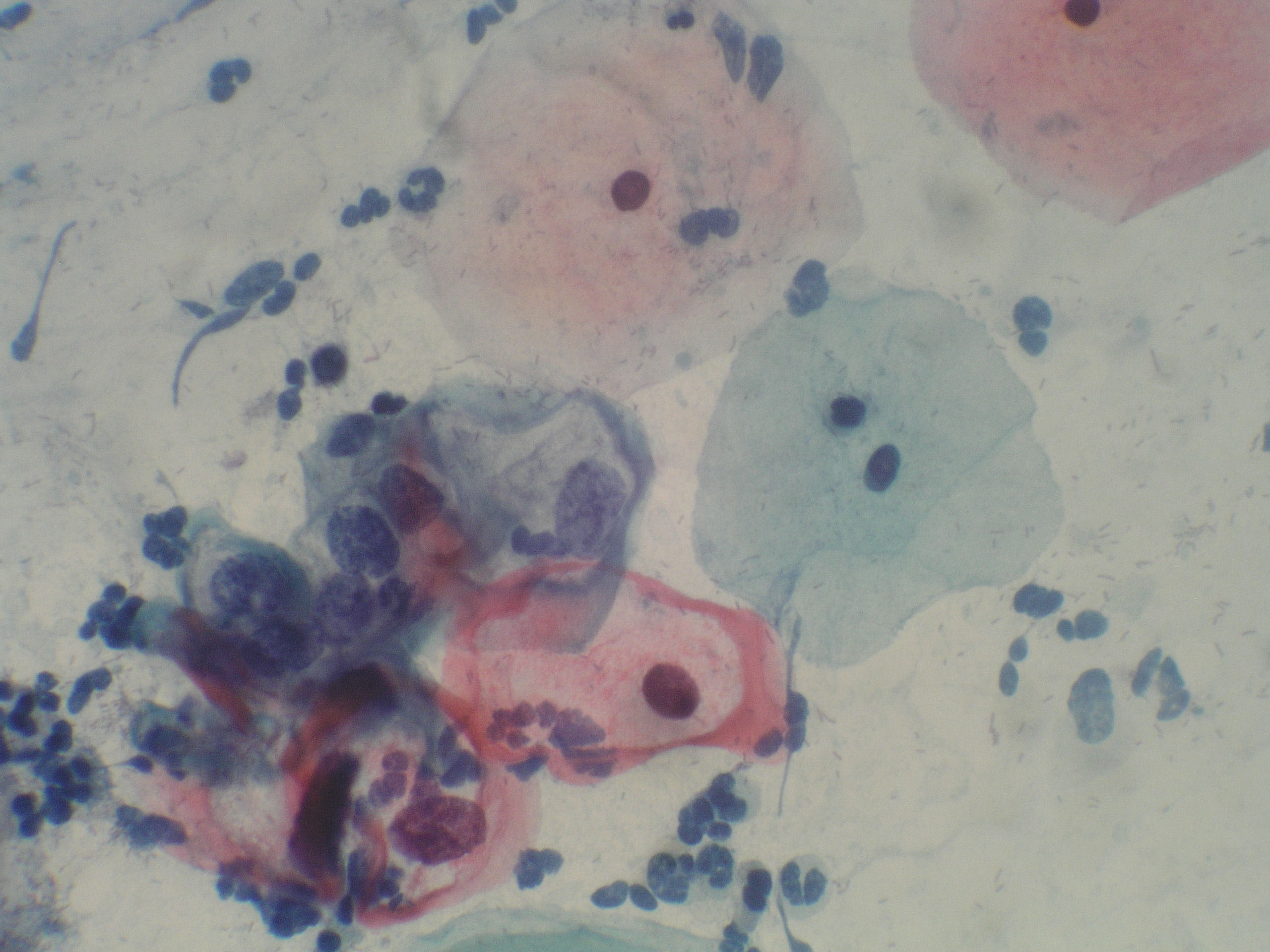 koilocytes 1 a