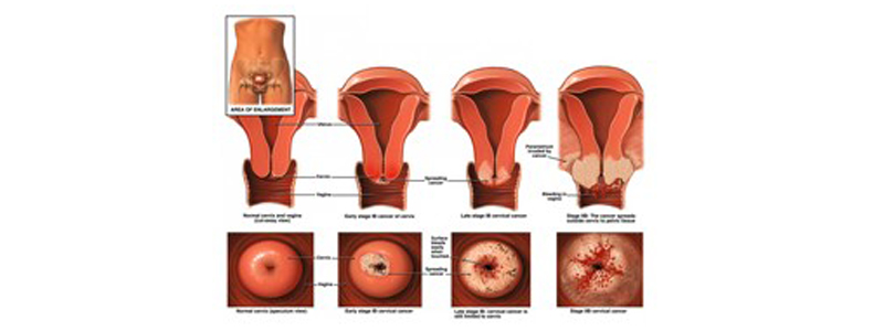 Ovules gynécologiques et irritations vaginales - Docteur Benchimol
