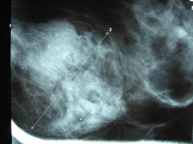 carcinome canalaire invasif sur hamartome sein 2