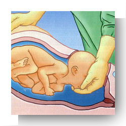 cesarienne extraction foetale 1