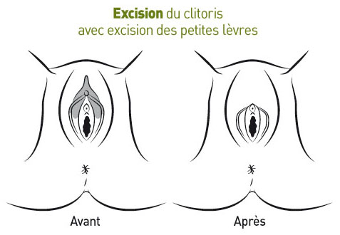excision classification 1