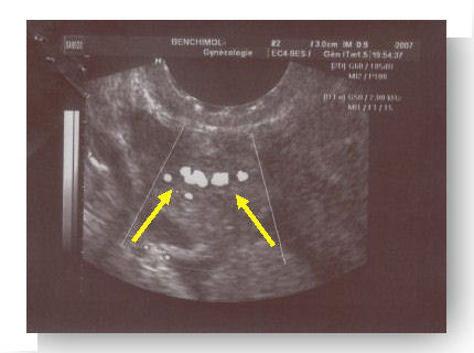 grossesse extra uterine 3 doppler