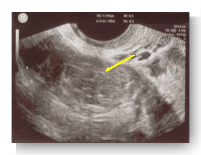 grossesse extra uterine corps jaune 2