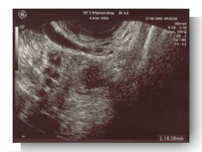 grossesse extra uterine echographie corps jaune