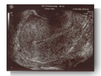 grossesse extra uterine echographie pseudo sac