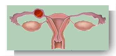 grossesse extra uterine isthmique