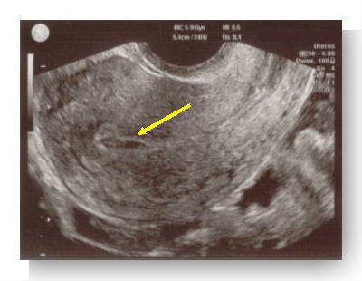 grossesse extra uterine pseudo sac 2