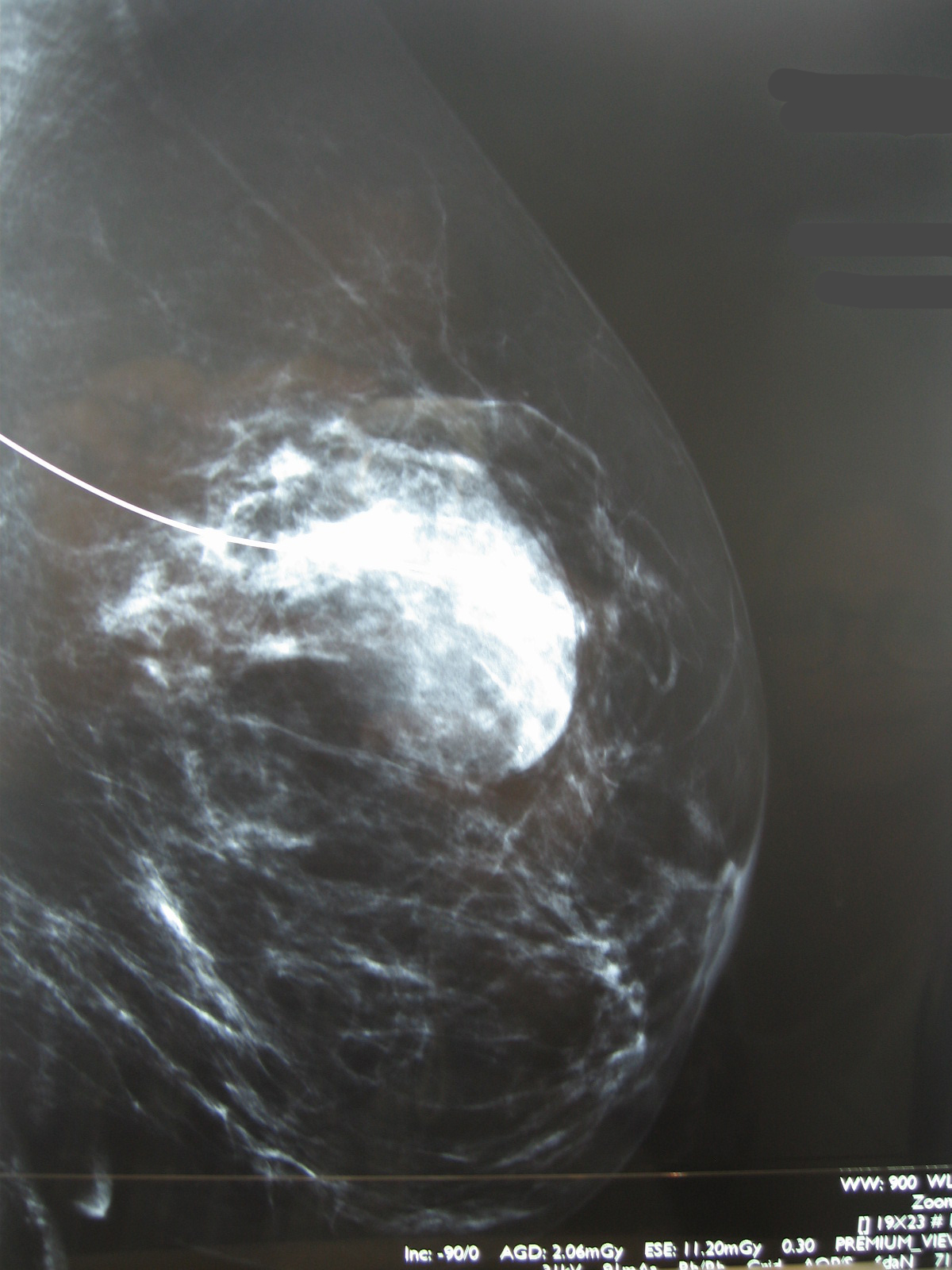 mammographie adenofibrome